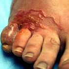 According to the Dr. Joseph F. Smith Medical Library Foundation, these small, round blood-sucking worms infest about 700 million people worldwide each year who are exposed to soil or sand contaminated with cat and dog  feces.